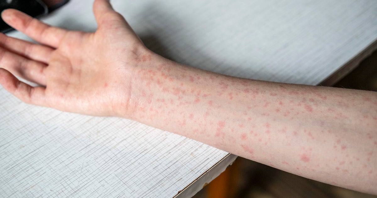 CDC dringt er bij zomerkampen op aan om te controleren op immuniteit van mazelen, aangezien de VS record nadert